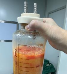 淮北水动力吸脂手术要做多久？